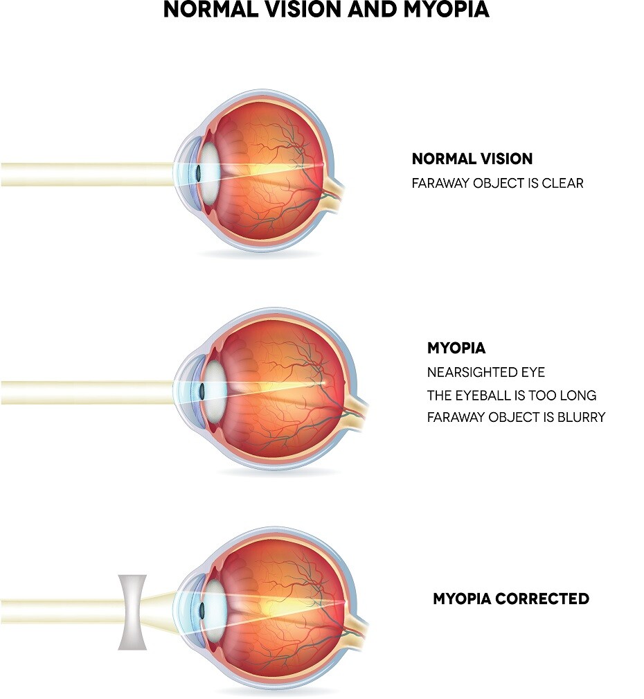 Myopia diagram